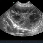extensive prostatic abscessation in a dog
