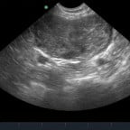 same prostate, subsequent to ultrasound guided drainage