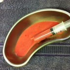 30ml pus removed via ultrasound-guided drainage